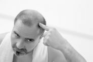 Trapianto di capelli